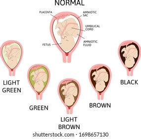 leaking early pregnancy|Signs of Leaking Amniotic Fluid vs. Discharge (& What to Do)